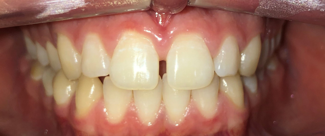 Antes ortodontia 4