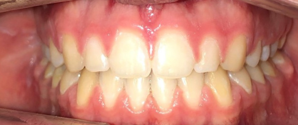 Depois ortodontia 4