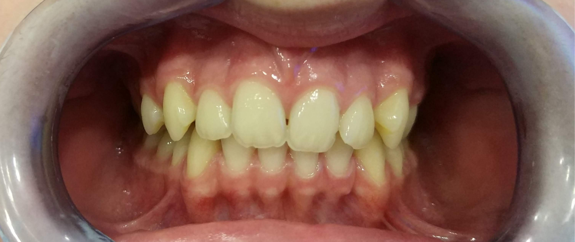 Ortodontia GrandoSmile Antes 4