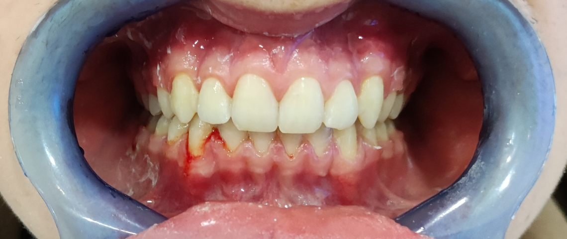 GranndoSmile ortodontia 4 depois