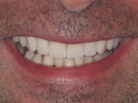 Dentes num só dia GrandoSmile